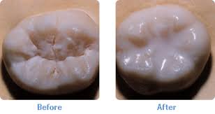 Example of Sealants Before and After - Eden Prairie Chanhassen Dentist Minnesota - Dr. Chi & Dr. Derr Family Dentistry