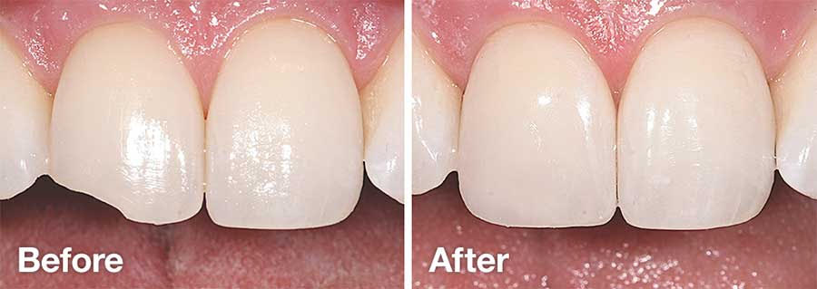 Before and After Dentist Teeth Example - Eden Prairie Chanhassen Dentist Minnesota - Dr. Chi & Dr. Derr Family Dentistry